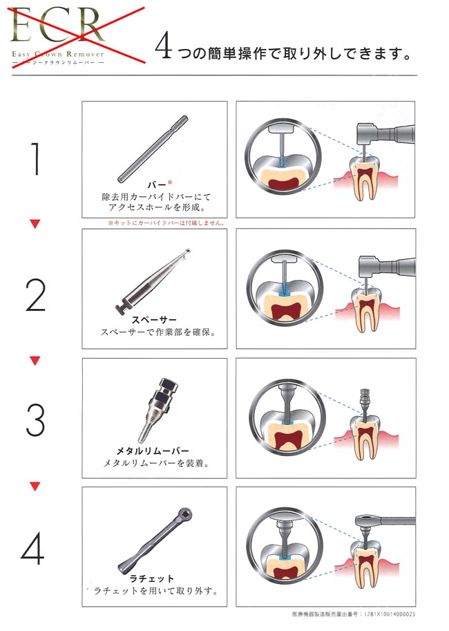 イージークラウンリムーバー