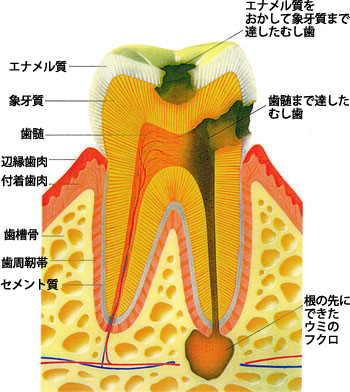 虫歯