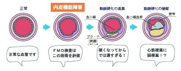 動脈硬化の進行