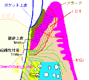 歯肉炎が起きた根面と歯槽骨、ＩＣＴの状態