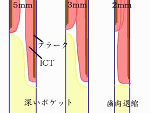 隣接面歯肉の厚みによる病的ポケットになるか歯肉退縮になるか