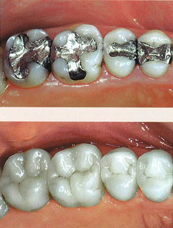 セラミックインレーで再修復した例