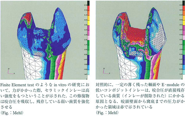 インレー修復の耐久性は低いと思われます