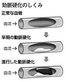 動脈硬化の仕組み